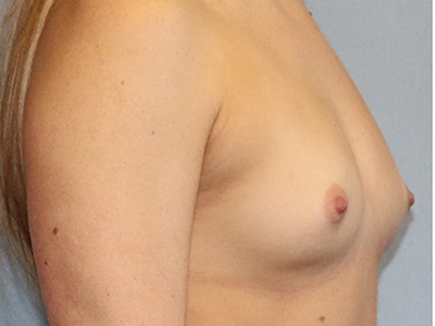 Breast Augmentation Before And After Photo