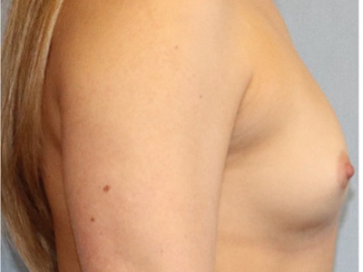 Breast Augmentation Before And After Photo