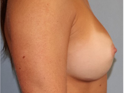 Breast Augmentation Before And After Photo