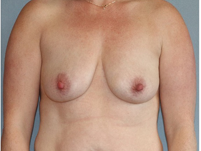 Breast Augmentation Before And After Photo