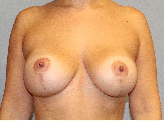 Breast Augmentation Before And After Patient 8