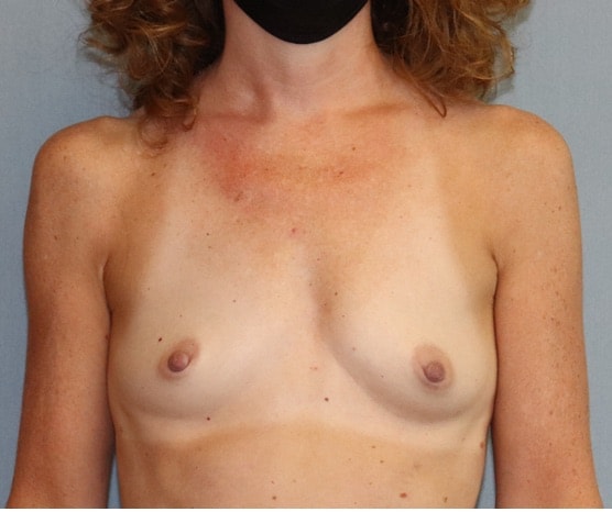 Breast Augmentation Before And After Photo