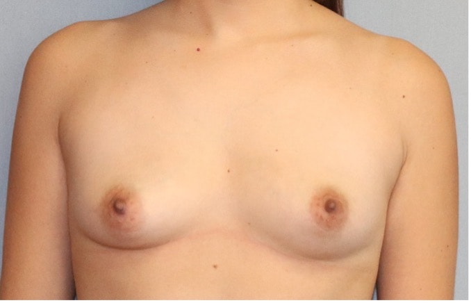 Breast Augmentation Before And After Photo