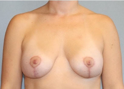 Breast Augmentation Before And After Photo