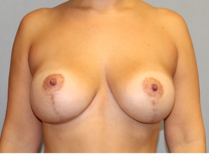 Breast Augmentation Before And After Photo