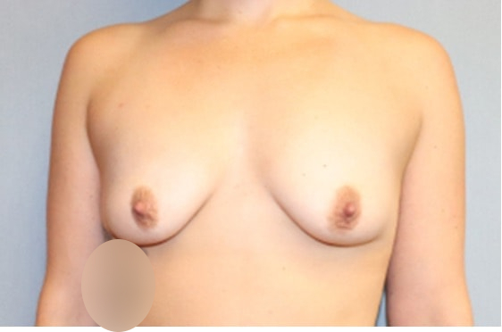 Breast Augmentation Before And After Photo