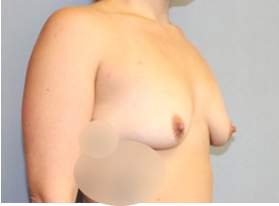 Breast Augmentation Before And After Photo