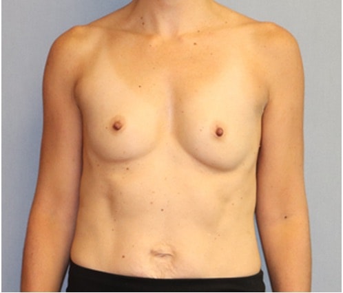 Breast Augmentation Before And After Photo