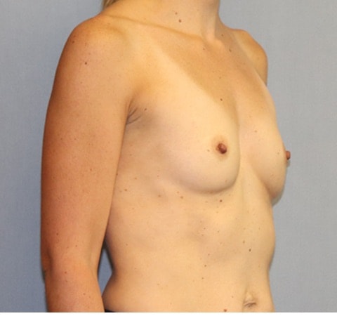 Breast Augmentation Before And After Photo