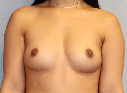 Breast Augmentation Before And After Photo