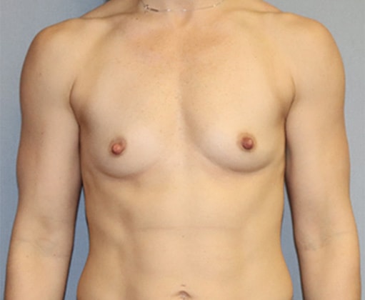 Breast Augmentation Before And After Photo