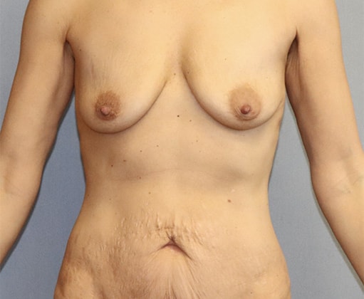 Breast Augmentation Before And After Photo