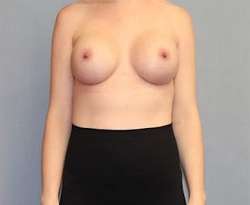 Breast Augmentation Before And After Patient 19