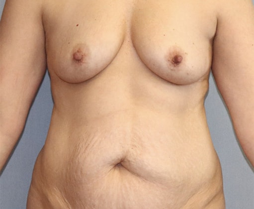 Breast Augmentation Before And After Photo