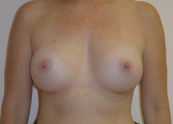 Breast Augmentation Before And After Patient 21