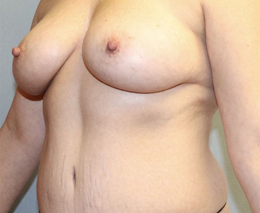 Breast Augmentation Before And After Photo