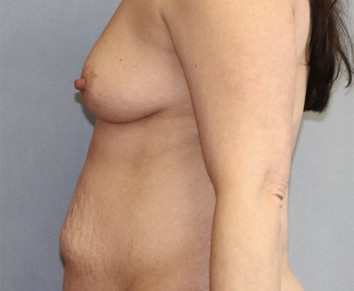 Breast Augmentation Before And After Photo