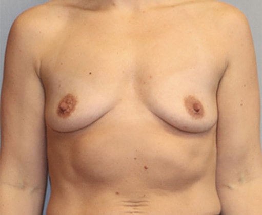 Breast Augmentation Before And After Photo