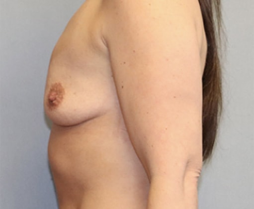 Breast Augmentation Before And After Photo