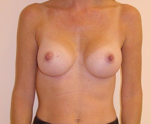 Breast Augmentation Before And After Patient 23