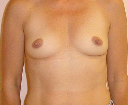 Breast Augmentation Before And After Photo