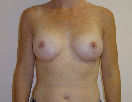 Breast Augmentation Before And After Patient 24