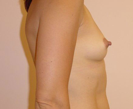 Breast Augmentation Before And After Photo