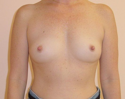 Breast Augmentation Before And After Photo