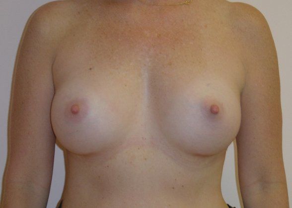 Breast Augmentation Before And After Photo