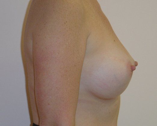 Breast Augmentation Before And After Photo