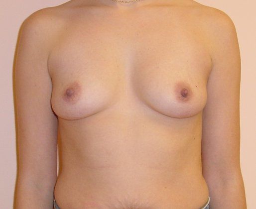 Breast Augmentation Before And After Photo