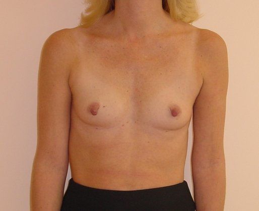 Breast Augmentation Before And After Photo