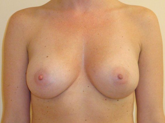Breast Augmentation Before And After Patient 27