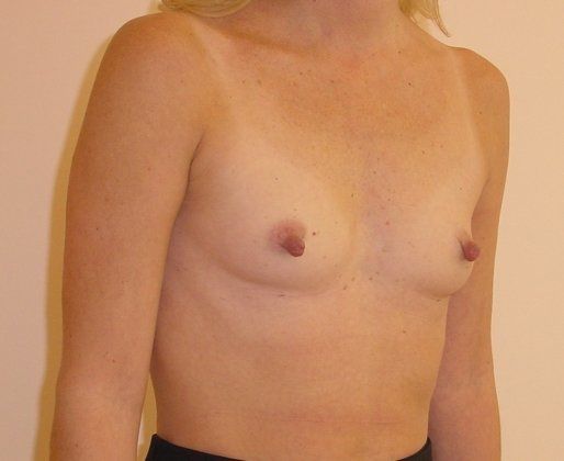 Breast Augmentation Before And After Photo