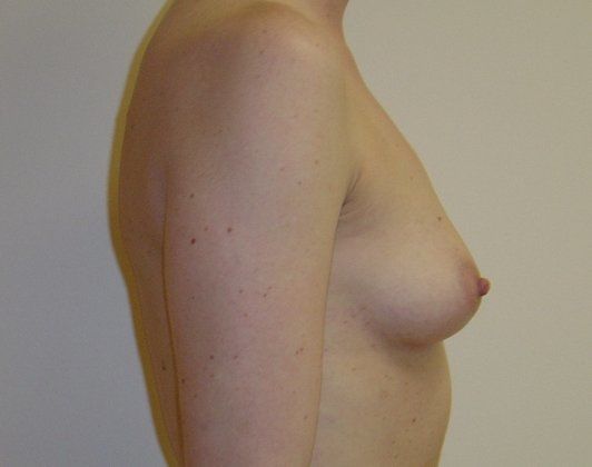 Breast Augmentation Before And After Photo