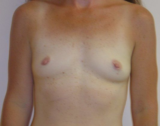 Breast Augmentation Before And After Photo