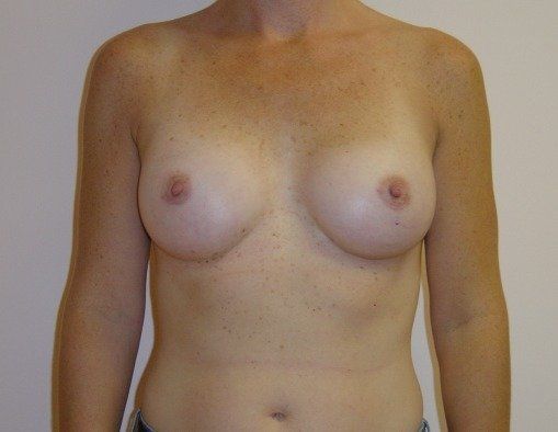 Breast Augmentation Before And After Patient 28