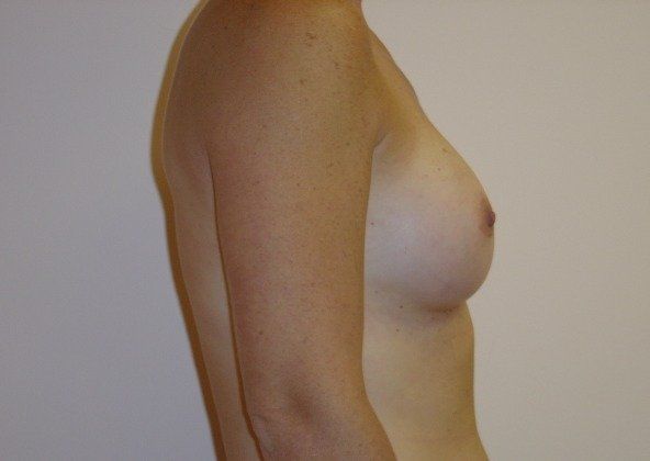 Breast Augmentation Before And After Photo