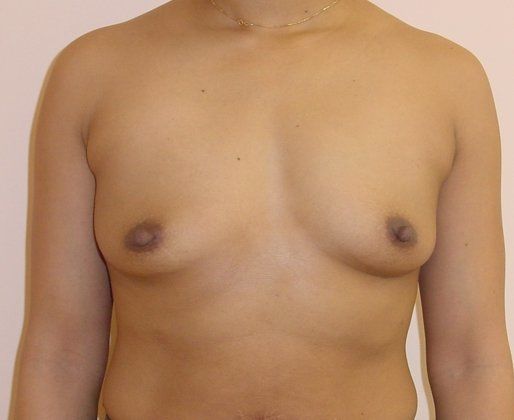 Breast Augmentation Before And After Photo