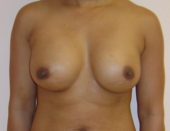 Breast Augmentation Before And After Photo