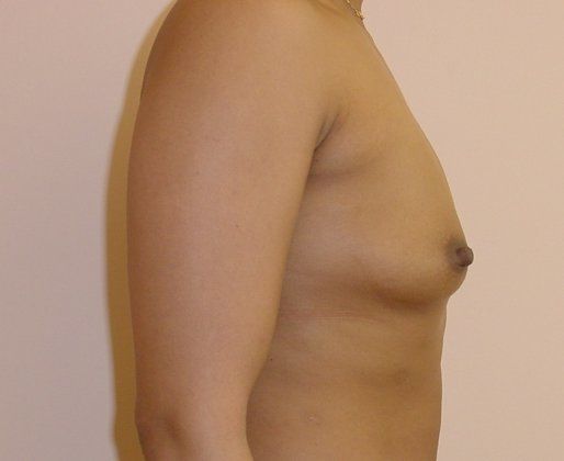 Breast Augmentation Before And After Photo