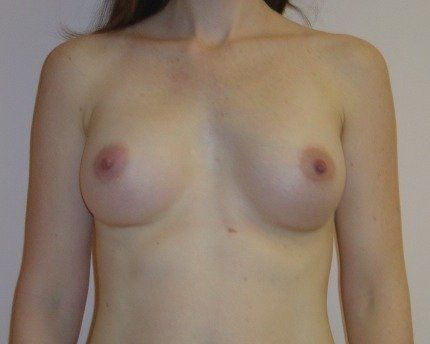 Breast Augmentation Before And After Photo