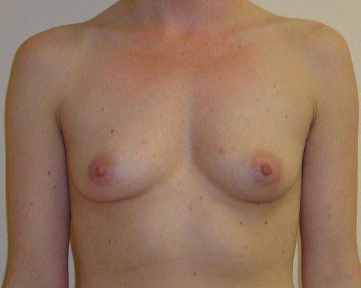 Breast Augmentation Before And After Photo