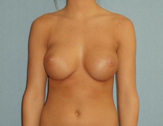 Breast Augmentation Before And After Patient 31