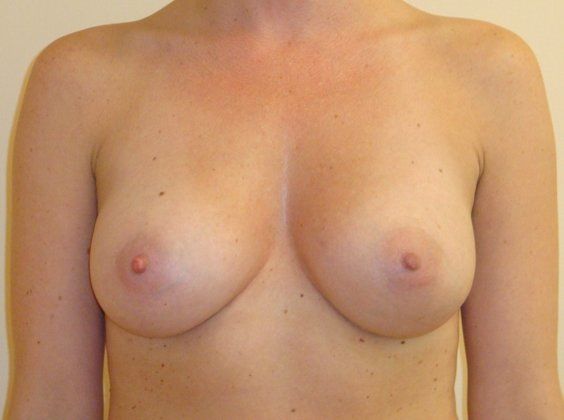 Breast Augmentation Before And After Photo