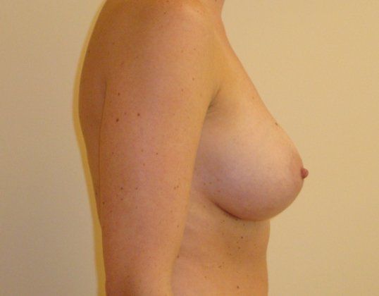 Breast Augmentation Before And After Photo