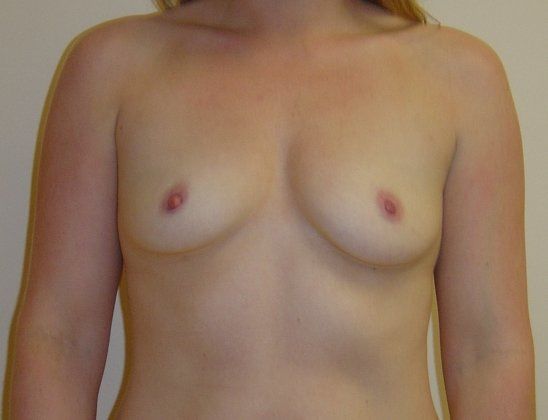 Breast Augmentation Before And After Photo