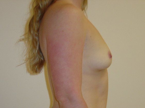 Breast Augmentation Before And After Photo