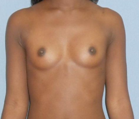 Breast Augmentation Before And After Photo