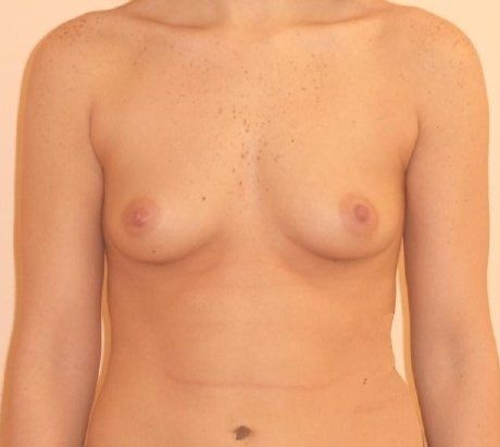 Breast Augmentation Before And After Photo